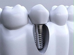 做种植牙全程需要多长时间呢?