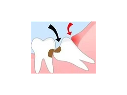 吃完饭后老塞牙？别大意！这可能是你的牙齿在报警