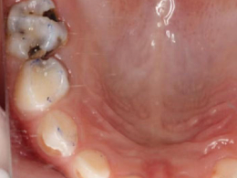 河北惟德口腔儿童涂氟，用专业守护孩子乳牙健康