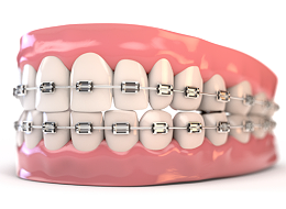 口腔正畸中常见的七个误区