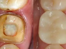 根管治疗（抽神经）后，为什么一定要做牙冠？