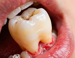 牙齿松动最佳补救方法