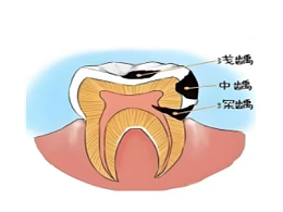 乳牙不是 “过渡品”——保护孩子牙齿从第一颗开始