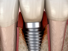 种植牙的术前准备有哪些？