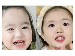 河北惟德口腔涂氟太贴心，孩子不抗拒，家长更省心